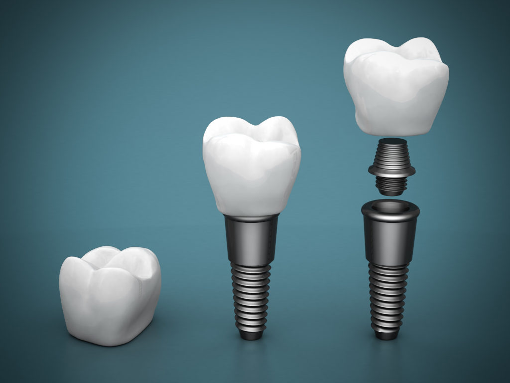 Fight Infection with New Dental Implants